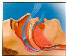 Nadciśnienie tętnicze
