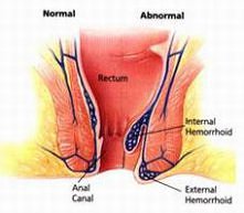 Hemoroidy leczenie i profilaktyka