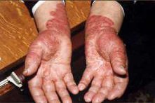 Choroby skóry - łuszczyca