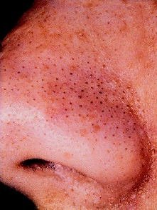 Sposób na wągry.
Zmieszaj r...