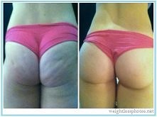 Z serwisu weightlossphoto net

Jest nadzieje na celulit!