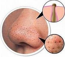 Aby pozbyć się czarnych zas...