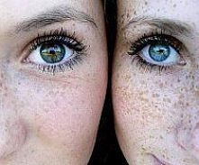 freckles *.*