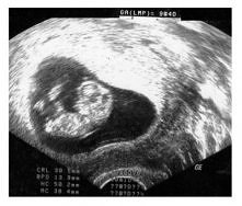 usg ciąży , przesłodkie <3