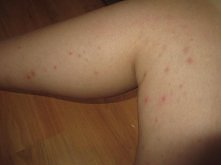 jak sie tego pozbyć??!! od jakiegoś czasu wyskakują mi pryszcze na całych nogach i pośladkach i potem robią takie strupy. to wygląda strasznie, nie moge ubierać któtkich spodene...