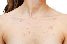 krostki na dekolcie - jak s...