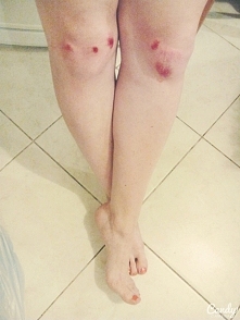 Macie sposób na zdarte kolana? Co zrobić by szybko się zagoiły? Pomocy!:(
A na przyszłość zachowajcie więcej rozsądku niż ja, kiedy to jadąc po deszczu 30km/h, po ulicy z idealn...