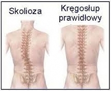 Wszystko na temat bocznego skrzywienia kręgosłupa, oraz ćwiczenia na poprawę postawy --> KLIK W ZDJĘCIE