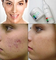 Przebarwienia, niedoskonałości, blizny, zmarszczki... Poznaj MOC KWASÓW...EFEKT ZABIEGU: skóra z widocznie zwężonymi porami, przebarwieniami i bliznami, skóra gładka i nawilżona...