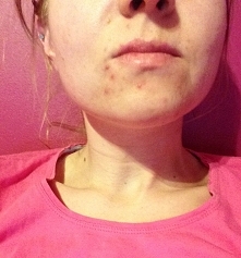 Hej dziewczyny! Mam problem z buzią :( jak sobie radzicie gdy macie taki wysyp ?