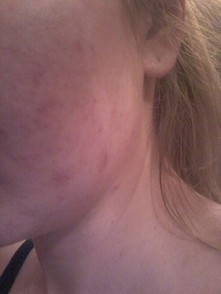 co polecacie na przebarwienia potradzikowe ?