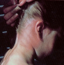 Zespół poboreliozowy – przyczyny, objawy, leczenie