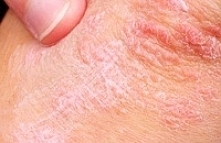 czy któraś z was też jest uczulona na nikiel i od ramiączek metalowych robią się plamki ? Może jest na to jakiś sposób ?