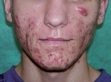 Olejek rycynowy na trądzik.