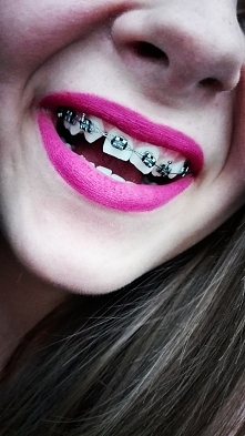 Minął miesiąc. Przyzwyczaiłam się już do drutów, czasami zapominam, że je mam. Jem już całkowicie normalnie. Zęby nie bolą, czasem się zdarzy, że pojedynczy boli przez dzień lub...