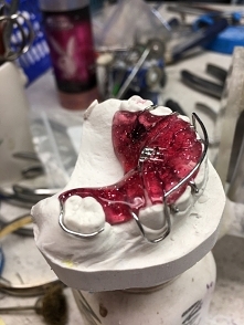 Płytka Schwarz’a ze śrubą Bertoniego i łukiem zstepującym 