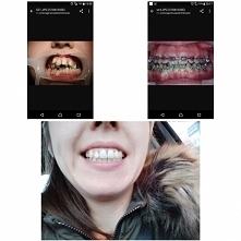 Tak wygląda moja cała metamorfoza po 4 latach noszenia aparatu. Jeśli ktoś mnie pamięta to wie, że nosiłam aparat 4 lata góra, na dole zaś 2 lata :) bardzo jestem zadowolona z t...