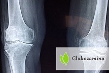 Glukozamina
