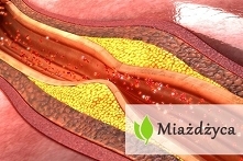 Miażdżyca - przyczyny, objawy, zapobieganie