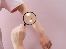 Czy usuwać znamiona? Zdecydowanie tak, bowiem niektóre z nich są szczególnie niebezpieczne i mogą przeistoczyć się w nowotwór skóry. Szczególnie niebezpieczne są te nieregularne...