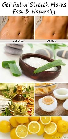 Jak się pozbyć rozstępów