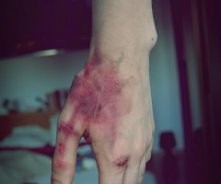 te blizny to pamiątki po tobie skarbie :)