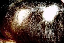 dziewczyny pomocy!!! mam łysienie plackowate czy któraś z Was miała? jak tak to jakieś propozycje, żeby z tym walczyć? Już próbowałam tylu rzeczy...może Wy znacie jakieś sposoby :(