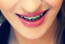 Pozdrawiam wszystkie "właścicielki" aparatu ortodontycznego!:)
Na zdjęciu mój uśmiech po roku noszenia drutów;)