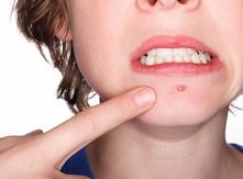 5 rzeczy przez, które masz pryszcze! Unikaj ich! KLIK w foto :)