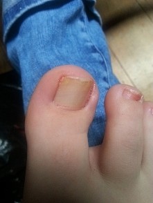 Pomocy. Używam odżywek, które pomagają mi na paznokcie u rąk i codziennie 2 razy czyszczę paznokcie. Moje paznokcie u stóp są żółte od lakieru, rozdwajają się i łamią bez powodu...