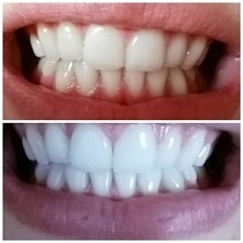 moje wybielanie po 2 użycia...