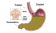 posiłki nie powinny być zbyt obfite. Lepiej zaplanować małe porcje jedzenia
kontroluj wagę i nie dopuść do otyłości
wyeliminuj alkohol i rzuć palenie.
unikaj żywności i napojów,...