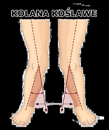 Koślawość kolan? Czy twoje kolana są prawidłowe? Sprawdź koniecznie (klik w zdjecie)