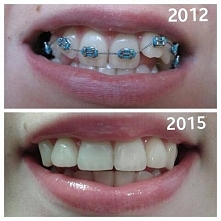 Po trzech latach, w końcu mogę się uśmiechnąć! :)