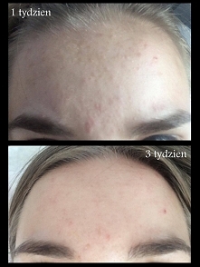 Przedstawiam Wam pierwsze efekty działania Izoteku. Pokazuję tylko zdjęcie czoła, ponieważ to z nim miałam największy problem. 

Obecnie jestem w końcu 4 tygodnia stosowania i m...