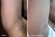 Jak zrobić w domu profesjonalny zabieg na rozstępy.. :)