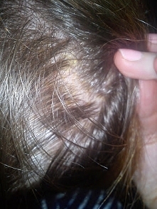 łupież, łuska, wypadające włosy. Wypisz-wymaluj ŁZS (łojotokowe zapalenie skóry). Nieuleczalna choroba? Już nie! Oto mi się ją udało pokonać. Szczegóły KLIK na zdjęcie;)