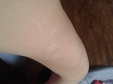 pomocy! czy ktoś mi może powiedzieć co to są te białe plamy na moim ramieniu? ktoś z Was też tak ma? jak sobie z tym radzic?