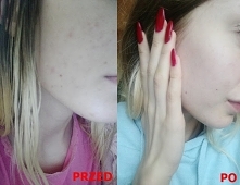 [kliknij w zdjecie,a przeniesie cie na bloga]
vissien.blogspot.com Masz problem z pryszczami, tradzikiem, przebrawieniami, bliznami czy peirwszymi zmarszczkami? zapraszam na moj...