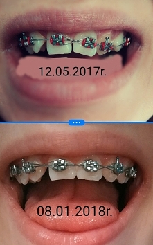 Taka dla mnie kolosalna różnica. Różnica 8 miesięcy, zleciało jak miesiąc. Jak aparat? Jest, albo go nie ma, po prostu czasem zapominam, że tam jest. Niedługo zakładam dolny łuk...