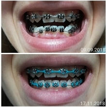 Pojawił się dół, pojawiła się OGROMNA różnica. Żeby założyć dół musiałam pozbyć się aż 3 zębów, lewa i prawa szóstka, które były już martwymi zębami po leczeniu kanałowym oraz o...