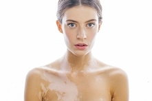 Bielactwo - przyczyny, objawy, leczenie