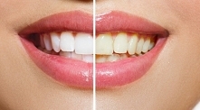 9 domowych sposobów na wybielenie zębów