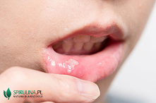 Jak pozbyć się aft domowymi...