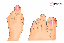 Siniak pod paznokciem